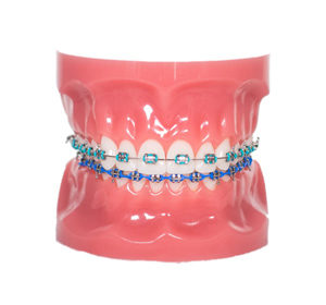 Braces in Hinsdale