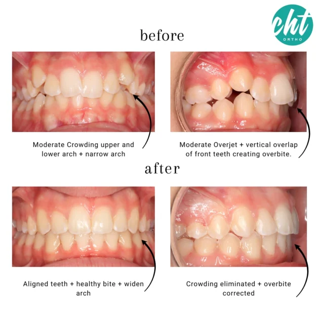Transformation Tuesday ✨ 🦷 

This beautiful smile transformation was achieved with braces! Our patient initially presented with moderate crowding in both upper and lower arches, a narrow arch form, moderate overjet, and vertical overlap of the front teeth with excessive overbite. Through comprehensive orthodontic treatment, we were able to align the teeth, eliminate the crowding, widen the arches, and correct the overbite—resulting in a healthier bite and more confident smile. It’s always rewarding to see the difference a well- planned treatment can make! 🙌🏼
#transformationtuesdays #bracesjourney #orthodontics #smiletransformation #alignedsmile #healthybite #chtortho